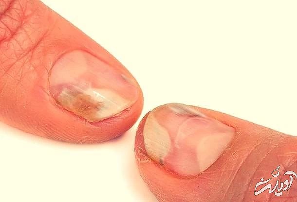 علت قارچ کاشت ناخن